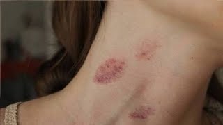 how to give someone a hickey in 3 minutes easy [upl. by Annyahs]