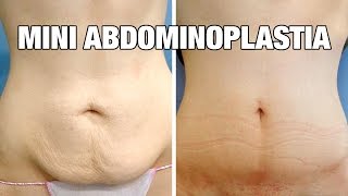 Mini Abdominoplastia antes y después  Testimonio Cristina [upl. by Hallsy]