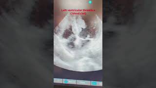 Left ventricular LV thrombus is a blood clot that forms in the hearts left ventricle [upl. by Enimsay]