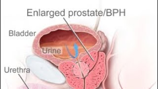 Prostatit Prostataförstoring Prostatacancer undersökning och Kirurgi hos Urolog i Stockholm [upl. by Sabas933]