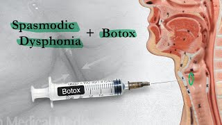 Spasmodic Dysphonia  When Botox Disappoints  Part 2 [upl. by Malkah]