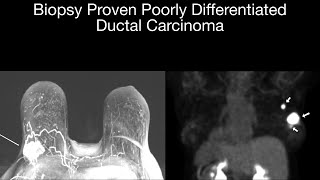 Biopsy Proven Poorly Differentiated Ductal Carcinoma [upl. by Scrogan965]