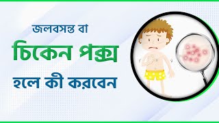 চিকেন পক্স বা বসন্ত হলে যা করবেন  Get Rid of Chicken Pox FAST  Heres the Secret [upl. by Margarette]