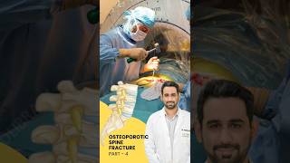 Treatment of Osteoporotic spine fracture  Dr Dheeraj Batheja  Part 2 doctor spinehealth [upl. by Washko]