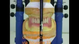 riabilitazione denti con protesi totale 2 [upl. by Akihsat136]