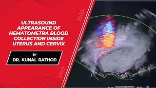 Ultrasound appearance of hematometra blood collection inside uterus and cervix  Dr Kunal Rathod [upl. by Natanoj]