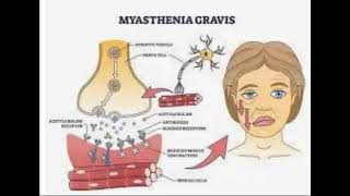 Myasthenia Gravis [upl. by Nylirehc]