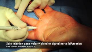 Live Surgery Digital Block Anesthesia of the Finger [upl. by Riocard227]