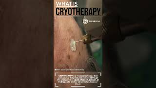 What is Cryotherapy Cryoablation or Cryosurgery medical mole skintreatment skin cryo [upl. by Arias639]