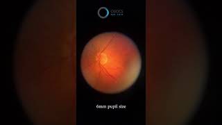 oDocs nun 6mm pupil and pseudophakic eye [upl. by Langston309]