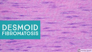 Desmoid Fibromatosis Desmoid Tumor  Explained by a Soft Tissue Pathologist [upl. by Dias]