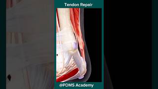 Tendon Repair  tendon rupture treatment anatomy education [upl. by Elleuqram120]