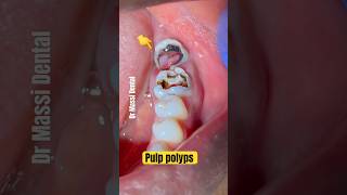 PULP POLYPS [upl. by Bennett469]