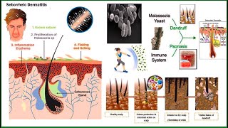 Seborrheic Dermatitis and Its Approach explained by Dr Makkar from Homeopathic website Askdrmakkar [upl. by Guadalupe]