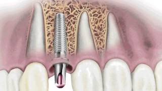 Duelen los Implantes Dentales [upl. by Akeryt227]