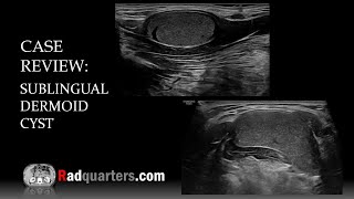 Ultrasound of Sublingual Dermoid Cyst [upl. by Aerol]