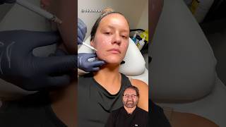 Face Lift Using Fillers Surgeon Reacts [upl. by Ellehsal]