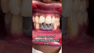 Regret Waiting to Fix Your Dental Implant Prosthesis [upl. by Micheil]