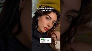 Brianna Chickenfry Nose Job briannachickenfry briannalapagalia barstoolradio revisionrhinoplasty [upl. by Aitat]