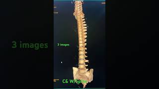 Cervical amp Whole Spine 3 Images [upl. by Herv]