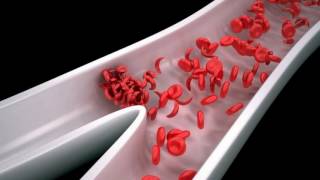 Difference Between Sickle Cell Disease and Sickle Cell Anemia [upl. by Nylek]