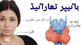 Thyroid  گلھڑ کا مرض Hyperthyroidism  Wajoohaat Nishaniyan ilaj [upl. by Duj]