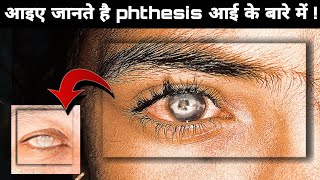 क्या आप जानते है Phthisis eye के बारे में  phthisis eye in Hindiphthisis eye  phthisis bulbi eye [upl. by Levine]