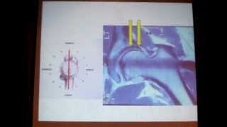 119  MRI arthrography in femoroacetabular impingement FAI [upl. by Seed966]