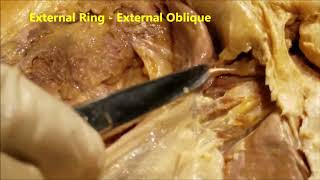 INGUINAL CANAL Surgical Anatomy – Indirect and Direct Hernia Pathology – Sanjoy Sanyal [upl. by Asyle]