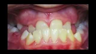 Underbite Correction Time Lapse Video Kyger Orthodontics [upl. by Eoj297]