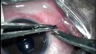 Scleral fixation suture IOL implantation [upl. by Dearman]