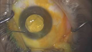 Secondary IOL implantation in the Sulcus [upl. by Aietal]