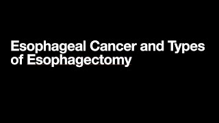 The Three Types of Esophagectomy [upl. by Saberio161]