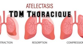SCANNER THORACIQUE  Foyer d’atélectasie [upl. by Cari]