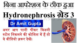 Cured case of Hydronephrosis Grade3 Homoeopathy did magic in Hydronephrosis [upl. by Ainala]