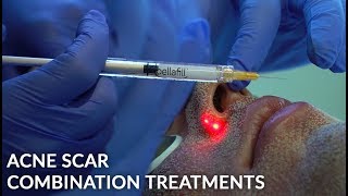 Acne Scar Treatment with Bellafill CO2 Laser amp Microneedling  Skin Resurfacing  Dr Jason Emer [upl. by Derrek]