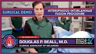 Interspinous Interlaminar Fusion Procedure Douglas P Beall MD [upl. by Gottlieb88]