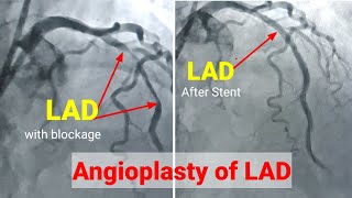 Angioplasty ll Angioplasty procedureRadial access Stenting of LAD हार्ट मैं छल्ला कैसे लगाते है [upl. by Frum399]