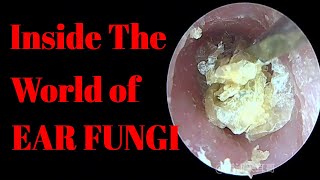 Inside The World of EAR FUNGI【Cleaning Earwax】 [upl. by Divadnhoj]