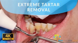 EXTREME TARTAR REMOVAL satisfying dental dentist [upl. by Hguh]