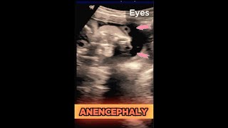 ANENCEPHALY  25wks Pregnancy  Baby without Head ultrasound pregnancy congenital baby [upl. by Nerat]