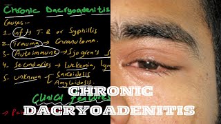 Chronic Dacryoadenitis  lacrimal system [upl. by Uella]