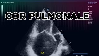 COR PULMONALE 2D ECHO [upl. by Kimmie]