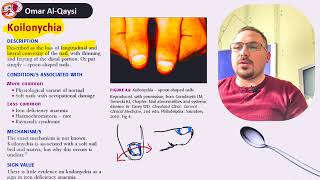 المعروف أيضا باسم الأظافر الملعقة│koilonychia [upl. by Holloway]
