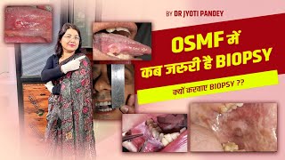 OSMF में कब जरुरी है BIOPSY क्यों करवाए BIOPSY [upl. by Prouty]