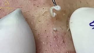 Loan Nguyen Acne Treatment 1464h [upl. by Ahs147]