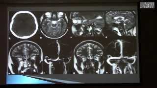 MRI CT Findings In Hydrocephalus with Increased Intracranial Pressure by Hamza Alsayouf [upl. by Sid833]