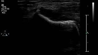 Ultrasound examination TENNIS ELBOW Lateral epicondylitis Chronic  osteophyte [upl. by Lacefield]