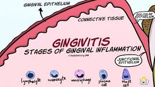 Gingivitis Stages of Gingival Inflammation [upl. by Eelyr312]