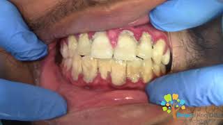 Dental Cleaning to remove heavy tartar🦷 【Young Male first cleaning】 [upl. by Nagar535]